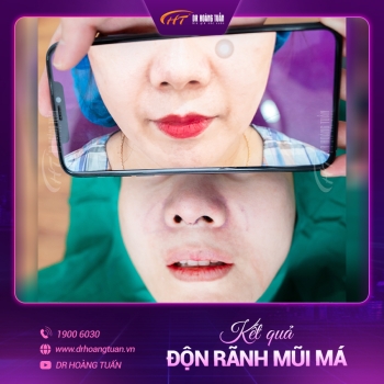 ĐỘN RÃNH MŨI MÁ